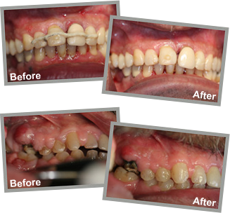 Patient Before and After Laser Gum Surgery, LANAP Gum Laser Procedure