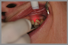 Gum disease treatment, dental laser, lanap gum laser