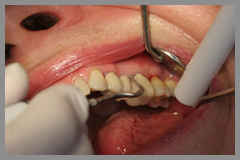 Gum disease treatment, dental laser, lanap gum laser