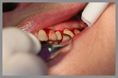 Gum disease treatment, dental laser, lanap gum laser