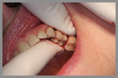 Gum disease treatment, dental laser, lanap gum laser