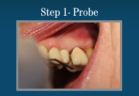 Step 1 - Painless Laser Gum Surgery