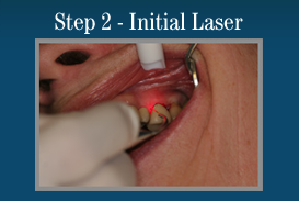 Painless Laser Gum Surgery