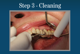 Step 3 - Painless Laser Gum Surgery