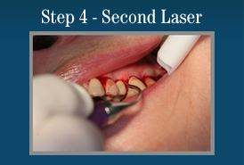 Step 4 - Painless Laser Gum Surgery