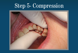 Step 5 - Painless Laser Gum Surgery