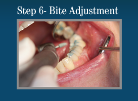 Step 6 - Painless Laser Gum Surgery