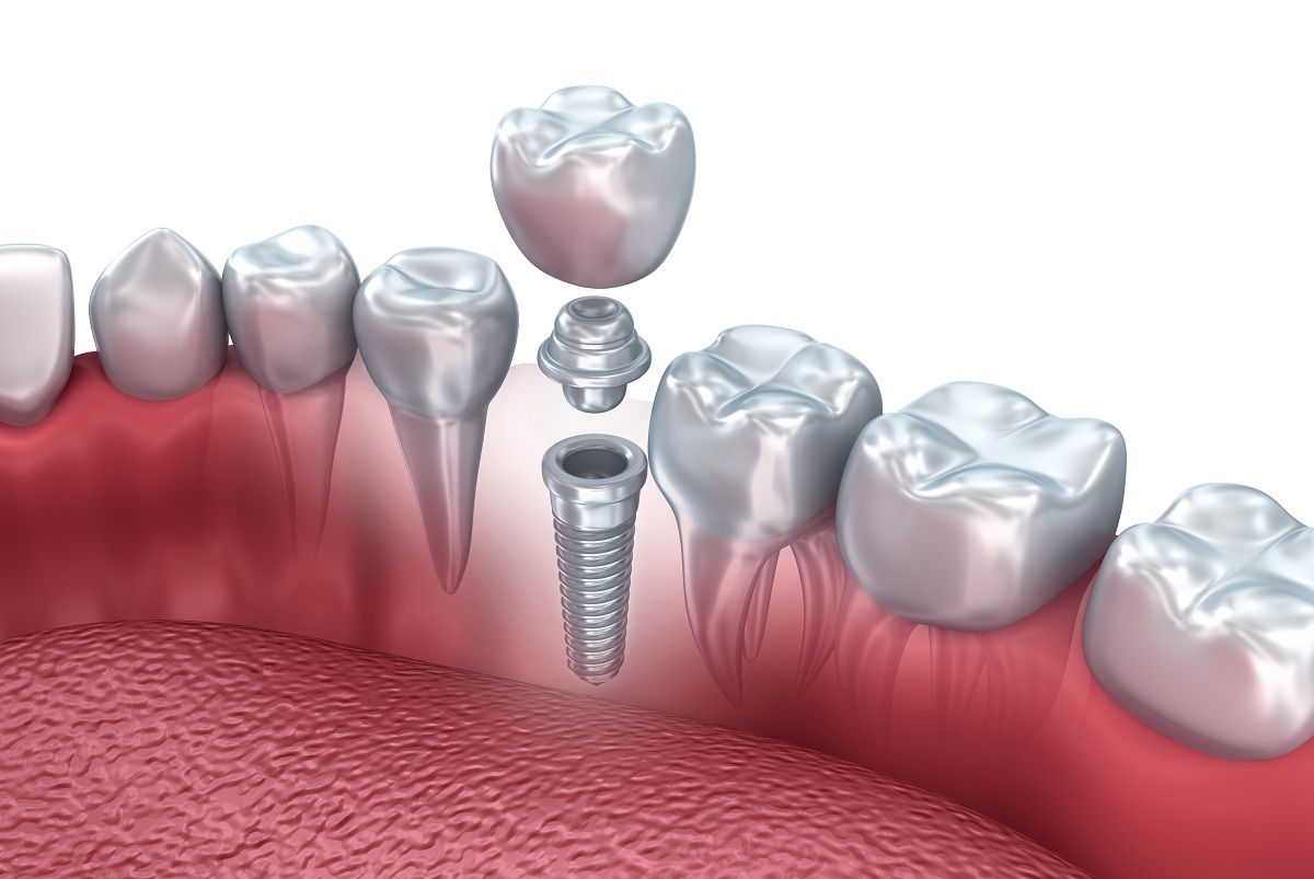 Dental Implant Complication Specialist